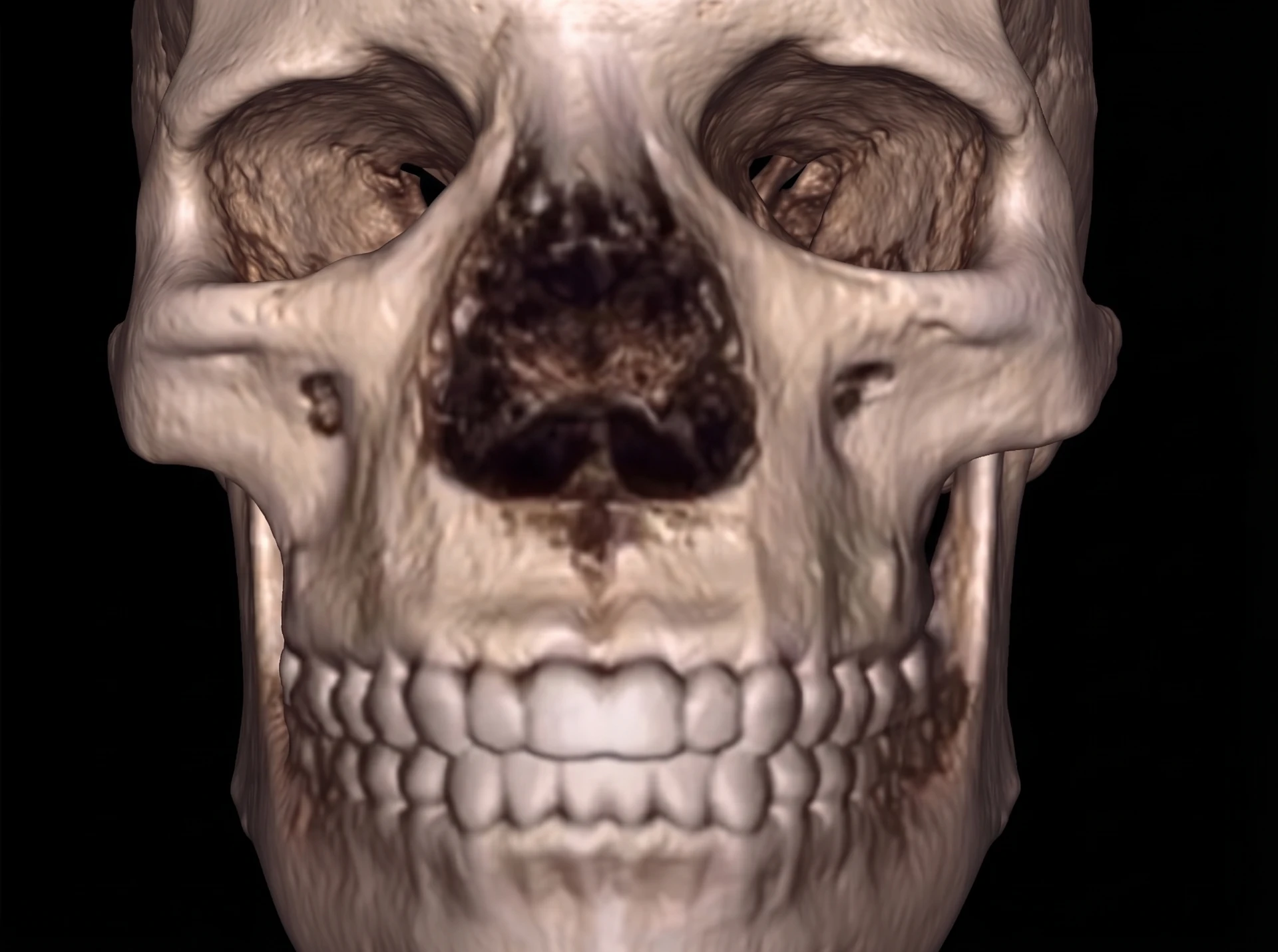 Reconstrução de tomografia 3D em vista frontal mostrando maxila estreita (atresia maxilar) antes da expansão