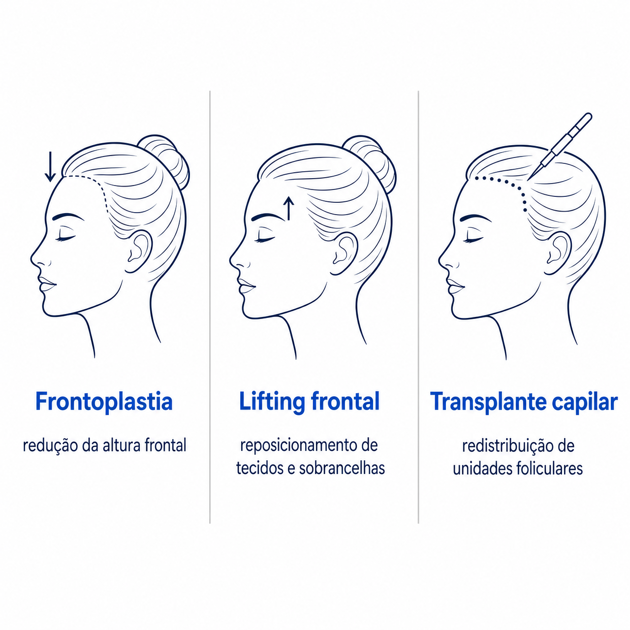 Diferença entre frontoplastia, lifting frontal e transplante capilar