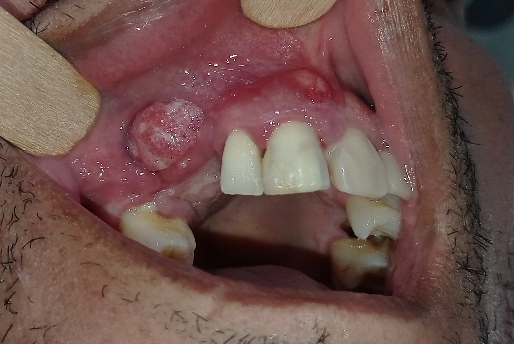 Lesão ulcerada na gengiva da região anterior superior