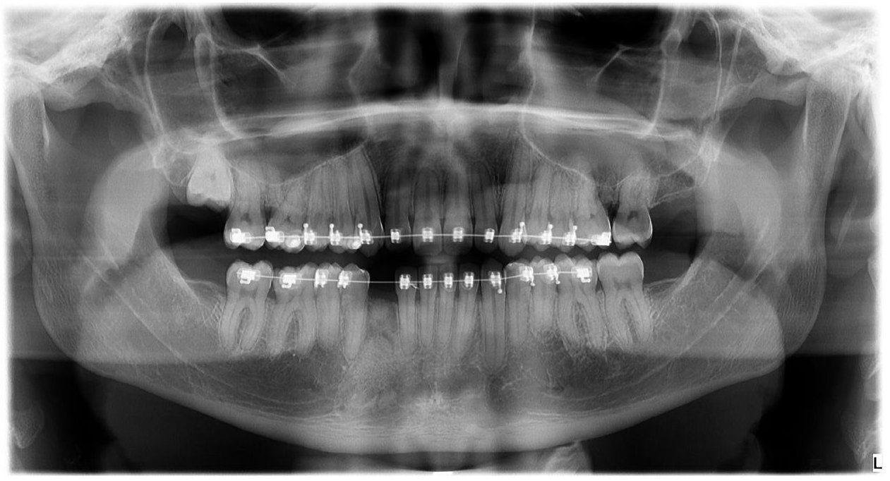 Radiografia panorâmica pós-operatória