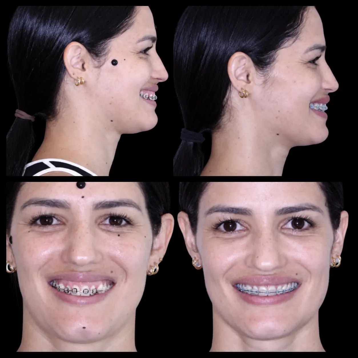 Antes e depois de cirurgia ortognática no Rio de Janeiro — Correção de Classe III com projeção do terço inferior. Fotos pré e pós-operatórias de paciente do Dr. Guilherme Lima, cirurgião bucomaxilofacial.