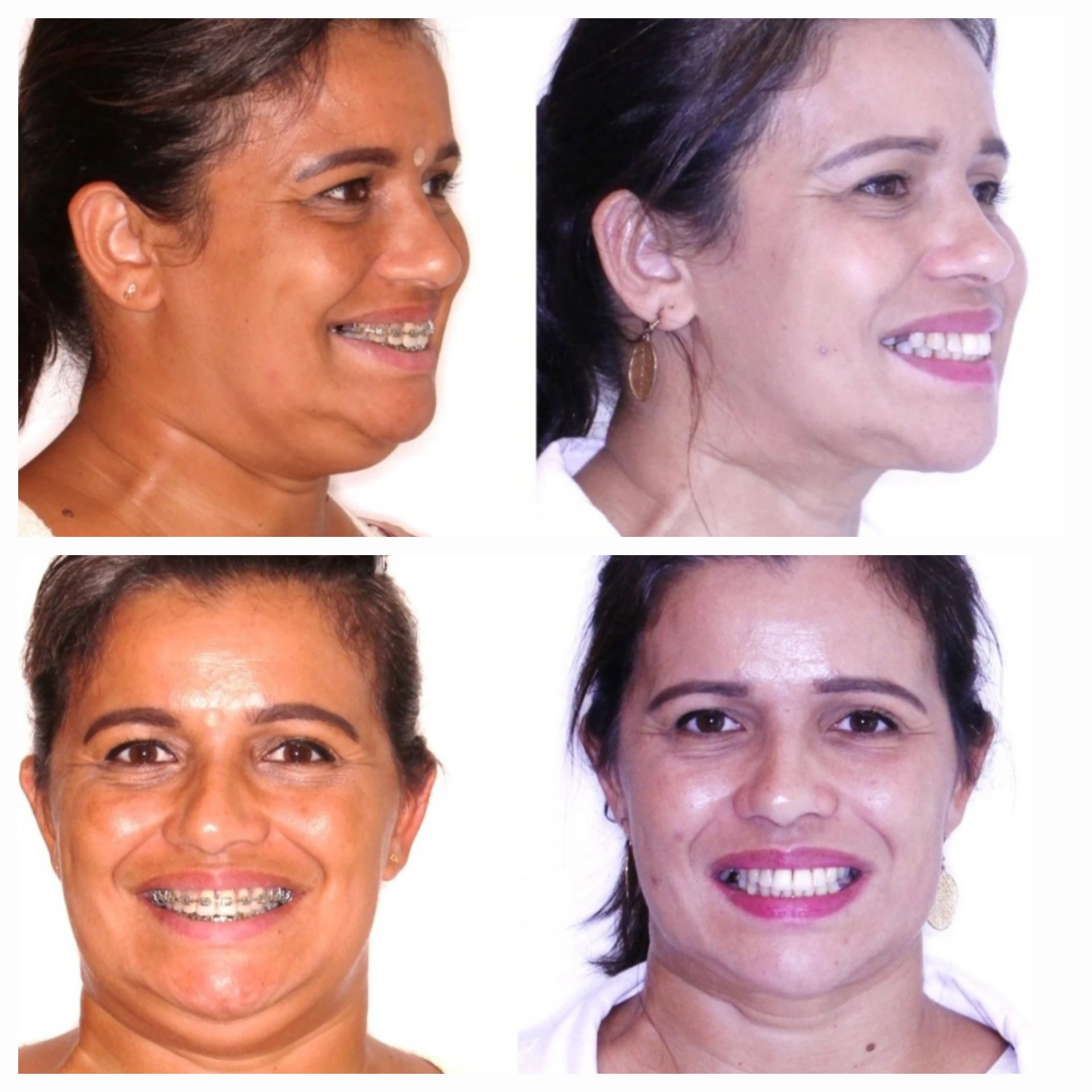 Antes e depois de cirurgia ortognática no Rio de Janeiro — Correção do terço inferior em paciente adulta — vistas frontal e três quartos. Fotos pré e pós-operatórias de paciente do Dr. Guilherme Lima, cirurgião bucomaxilofacial.