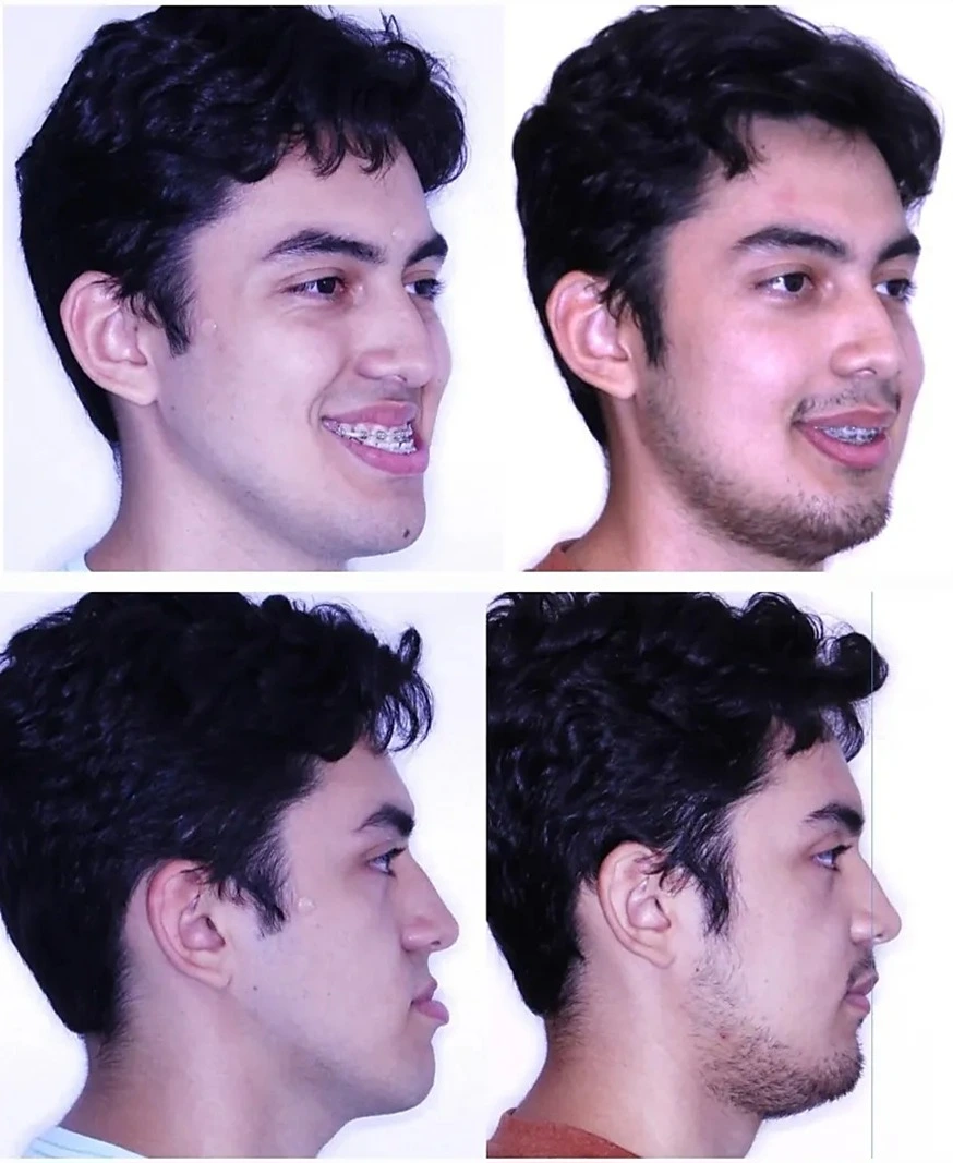 Antes e depois de cirurgia ortognática em Angra dos Reis — paciente masculino adulto, comparativo de perfil, cirurgia bucomaxilofacial