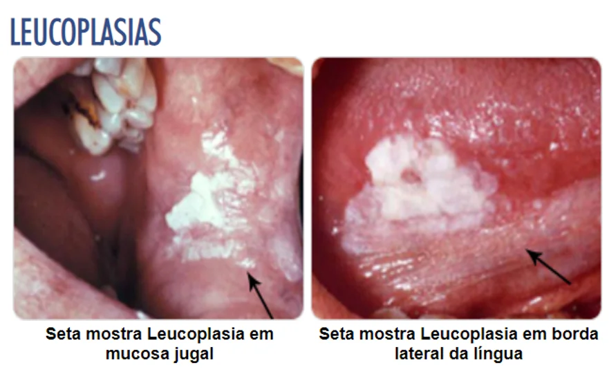 Leucoplasias na mucosa da bochecha e na borda lateral da língua indicadas por setas