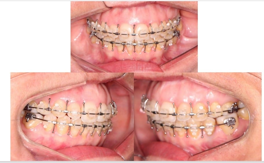 Vistas intraorais frontal e laterais de aparelho fixo cirúrgico com brackets e ganchos nas duas arcadas