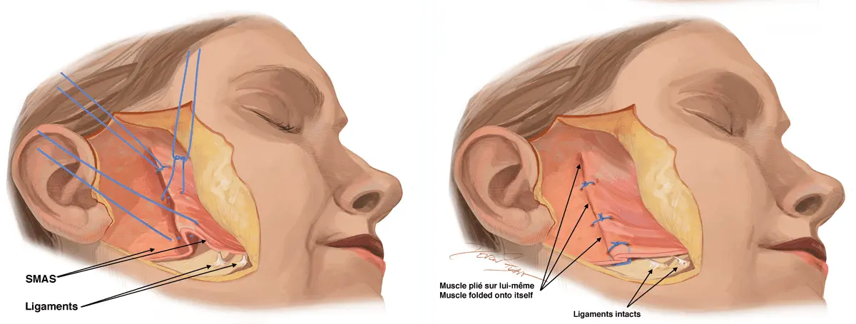 Ilustração anatômica em corte lateral da face mostrando o SMAS, os ligamentos de retenção e o plano profundo abordado no Deep Plane Facelift