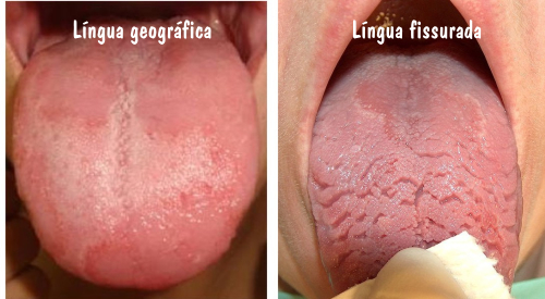 Comparação entre língua geográfica e língua fissurada