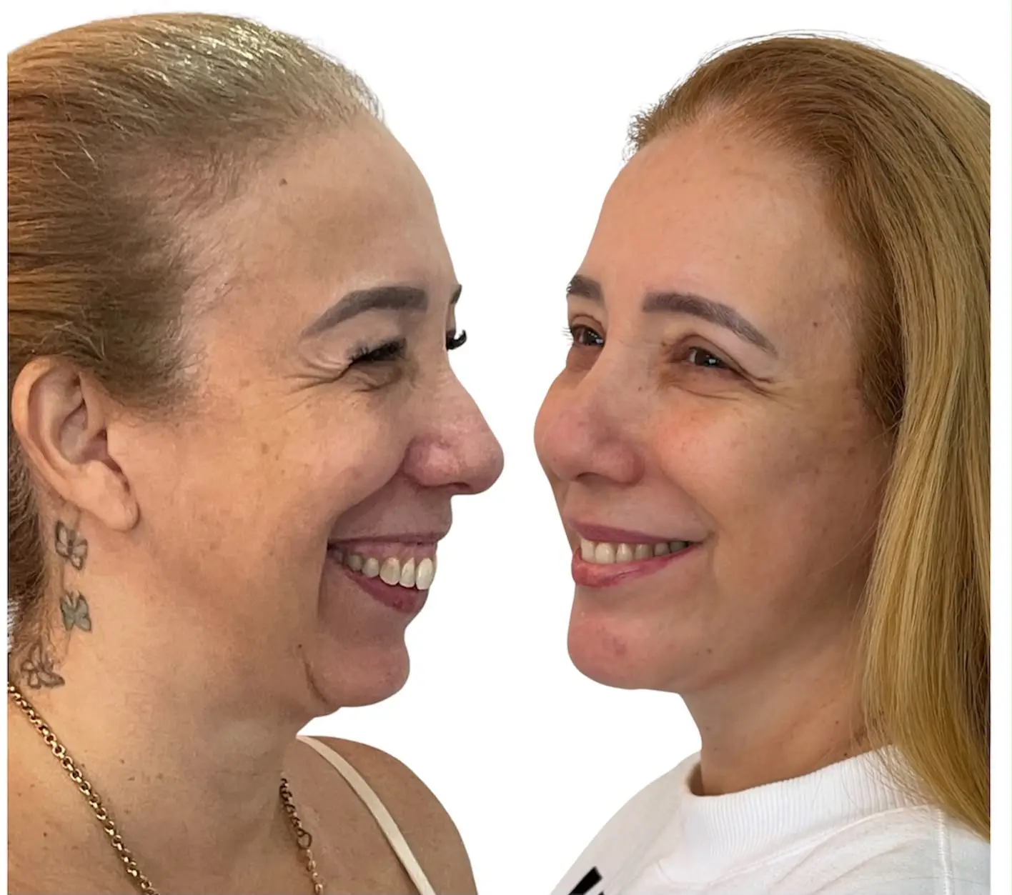 Vista oblíqua pré e pós-operatória de facelift associado a mentoplastia