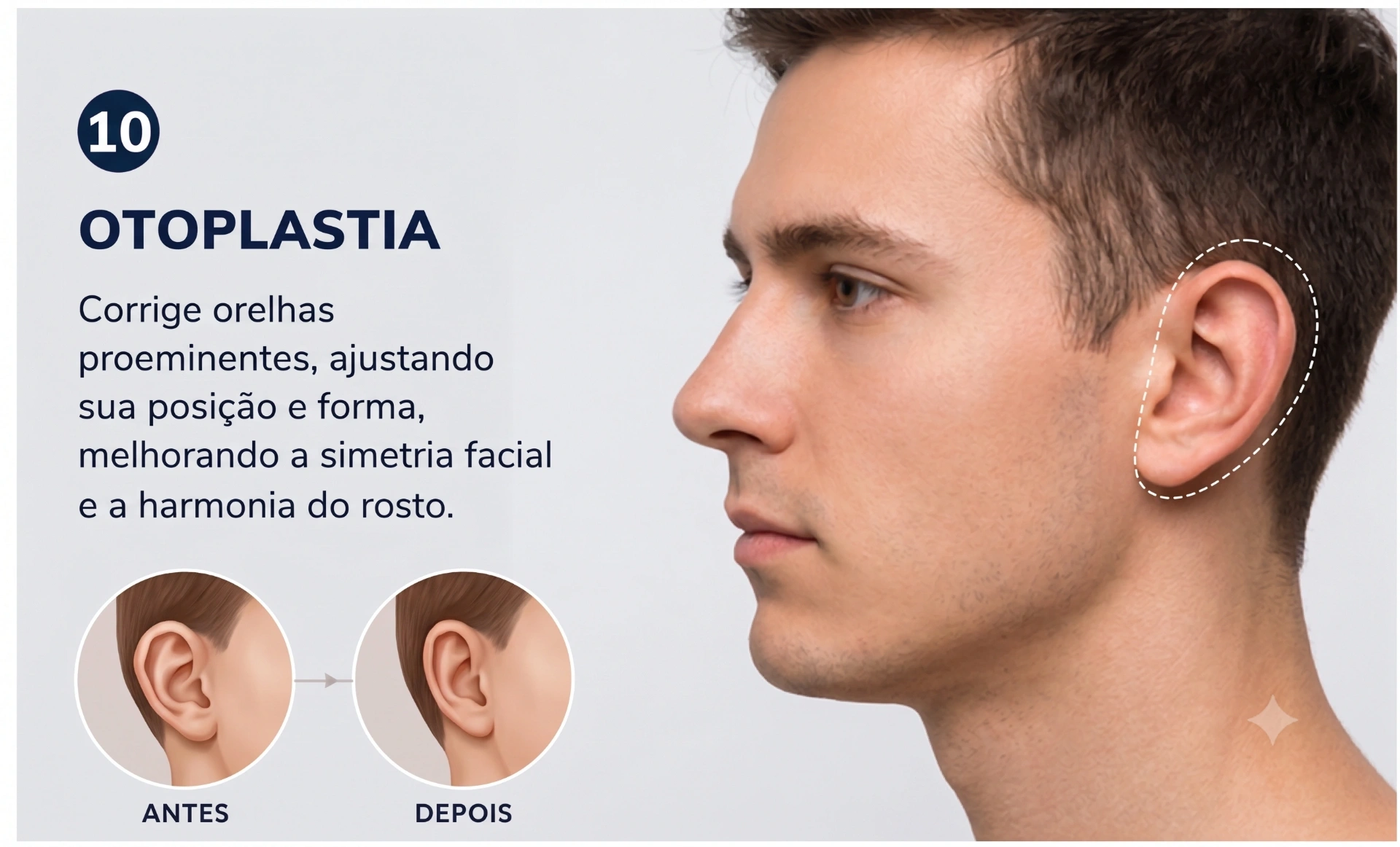 Otoplastia — correção de orelhas proeminentes