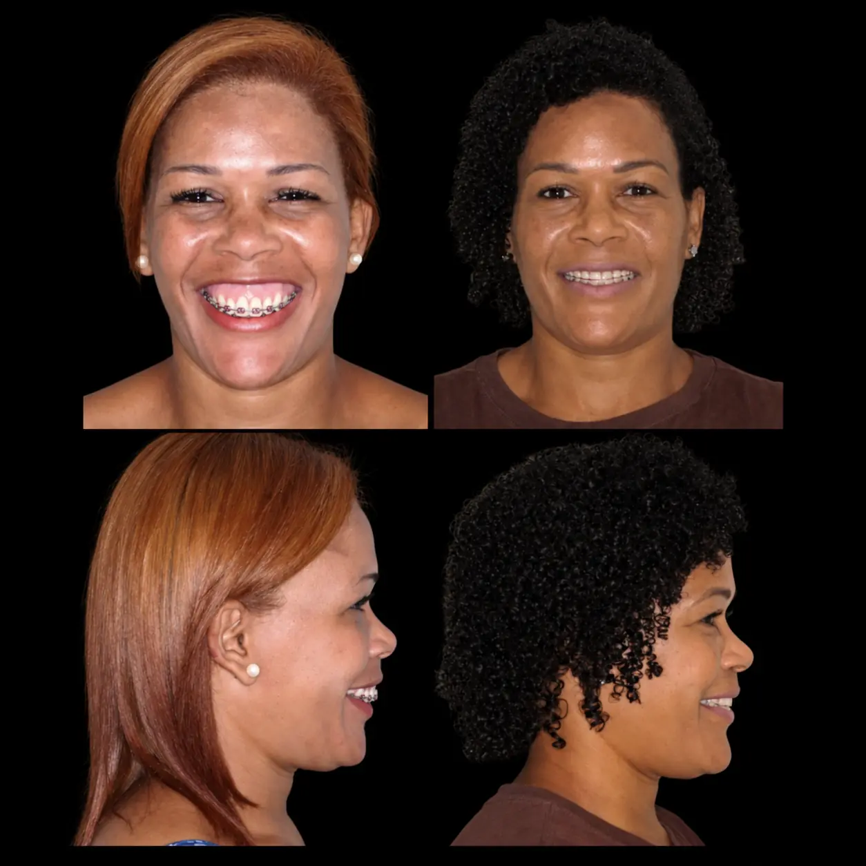 Antes e depois de cirurgia ortognática no Rio de Janeiro — Correção de mordida com harmonização do sorriso e do perfil. Fotos pré e pós-operatórias de paciente do Dr. Guilherme Lima, cirurgião bucomaxilofacial.