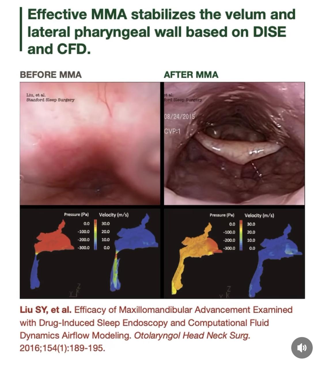 Estudo de Liu SY et al. (2016) demonstrando estabilização velofaríngea e redução de resistência inspiratória via DISE e CFD