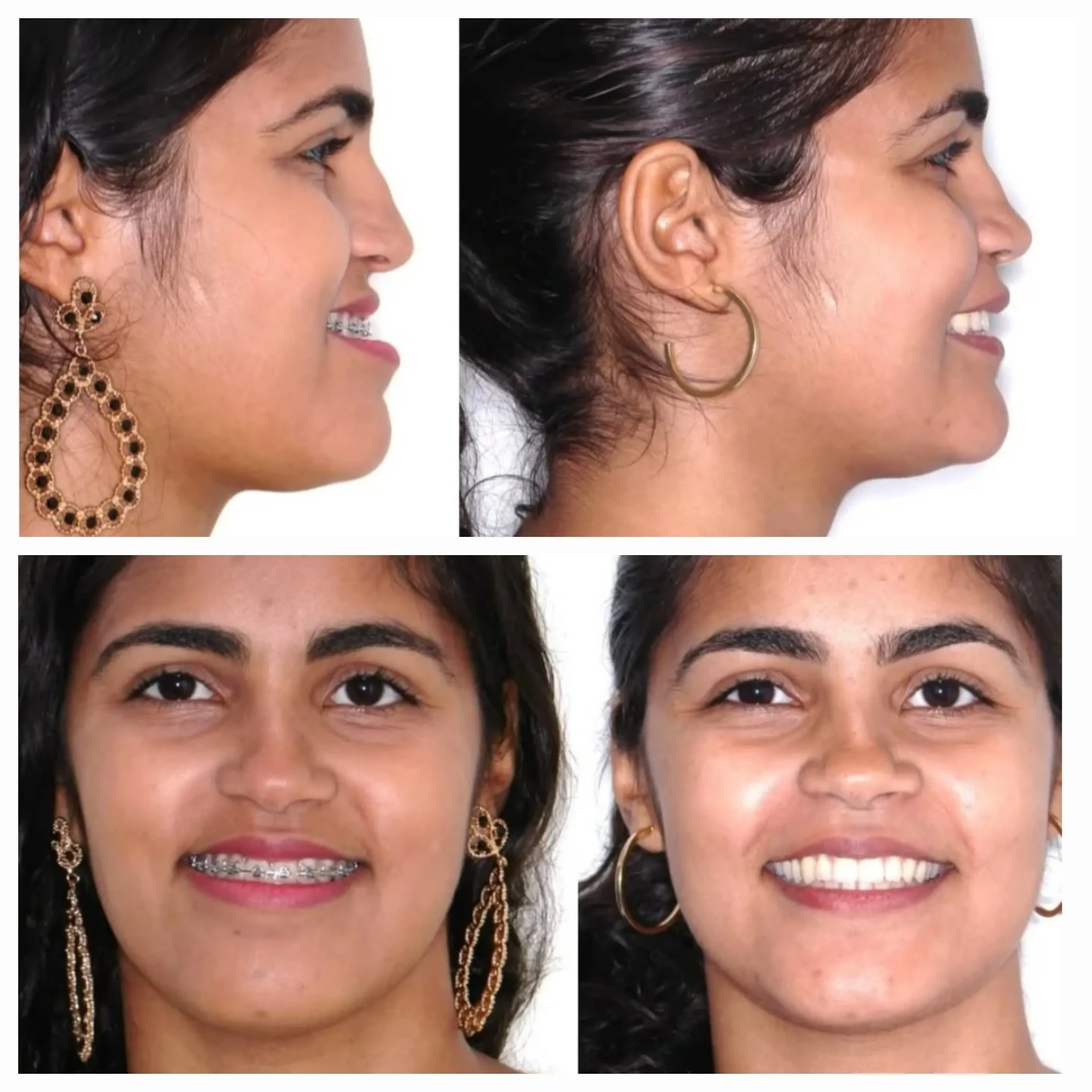 Caso clínico de prognatismo mandibular: perfil e vista frontal antes, com queixo projetado e aparelho ortodôntico, e depois da cirurgia ortognática, com perfil facial equilibrado