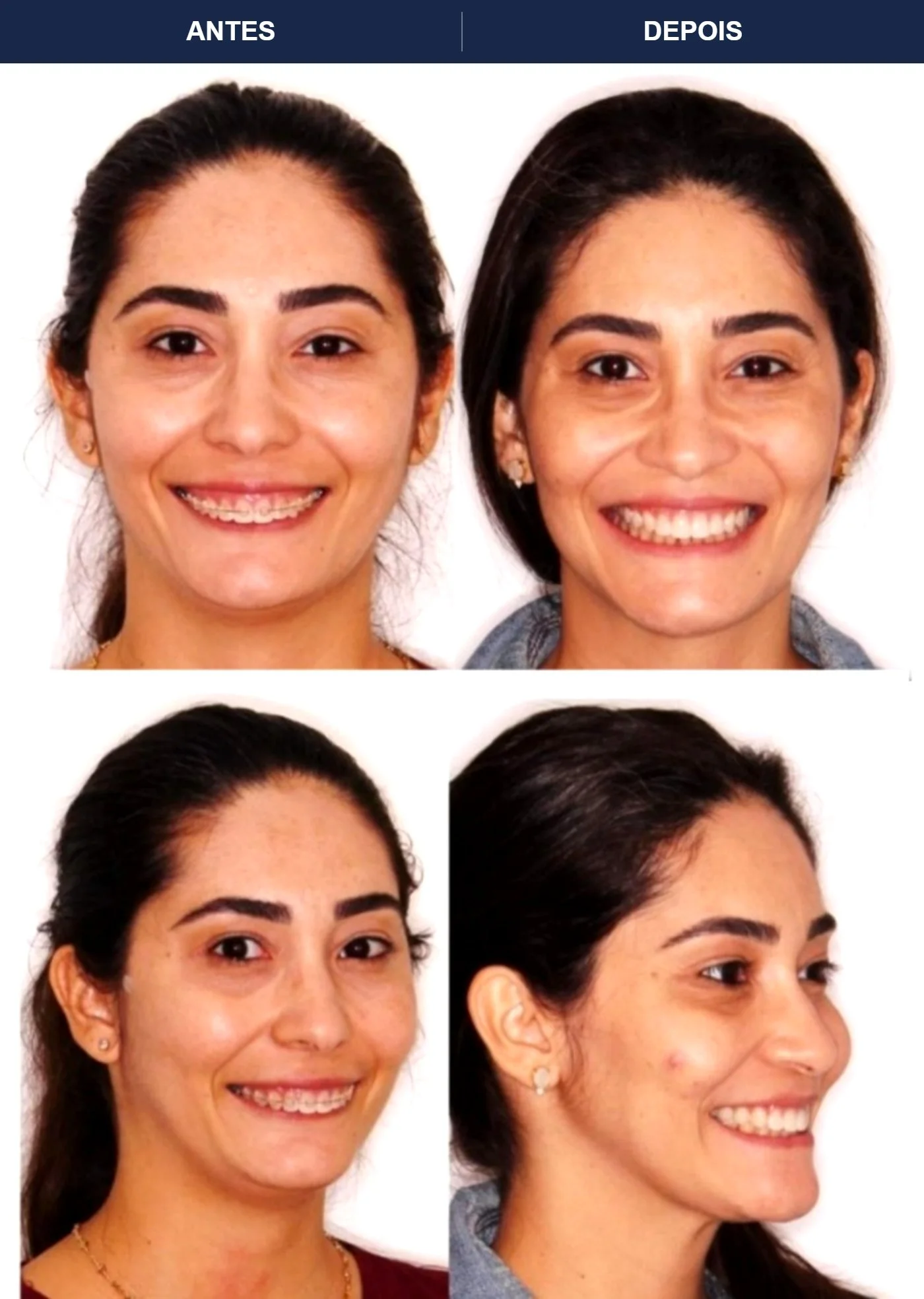 Caso clínico de cirurgia ortognática — Correção de mordida e harmonização do sorriso. Imagens pré e pós-operatórias.