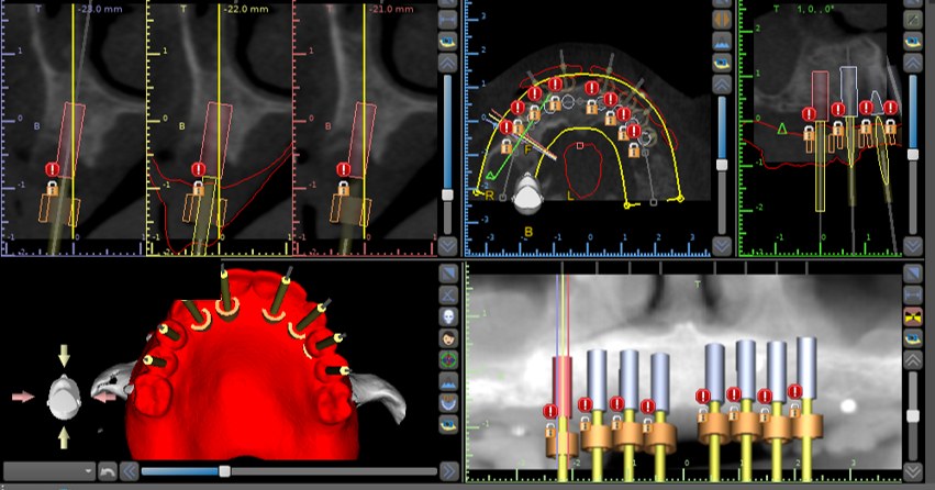 Software de planejamento com cortes tomográficos e implantes posicionados virtualmente