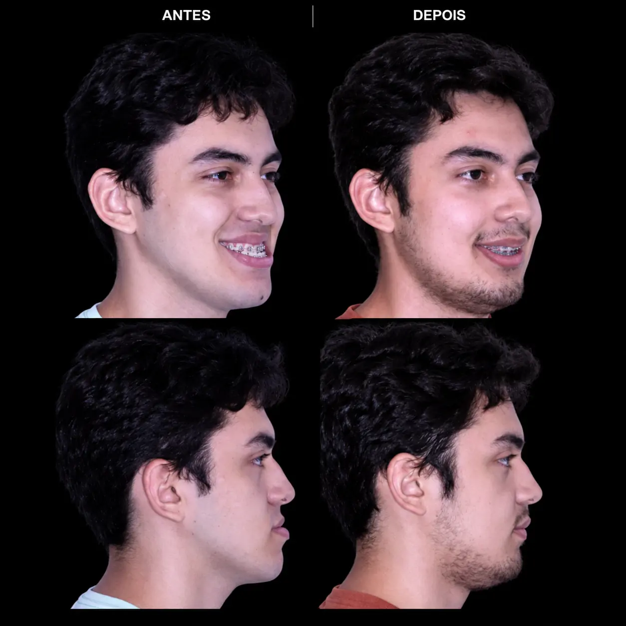 Antes e depois de cirurgia ortognática no Rio de Janeiro — Correção de Classe II com equilíbrio facial. Fotos pré e pós-operatórias de paciente do Dr. Guilherme Lima, cirurgião bucomaxilofacial.