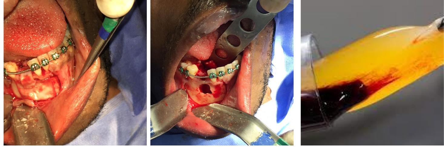 Cirurgia de remoção do canino incluso e enxerto com osso xenógeno e L-PRF