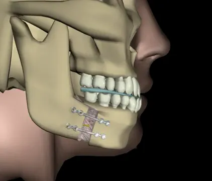 Animação 3D do avanço mandibular no tratamento da Classe II
