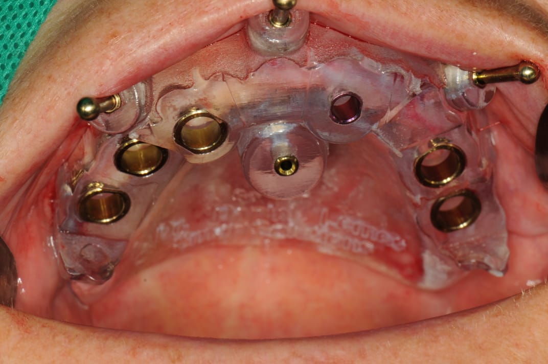Guia cirúrgico impresso em 3D com anilhas metálicas posicionado no maxilar