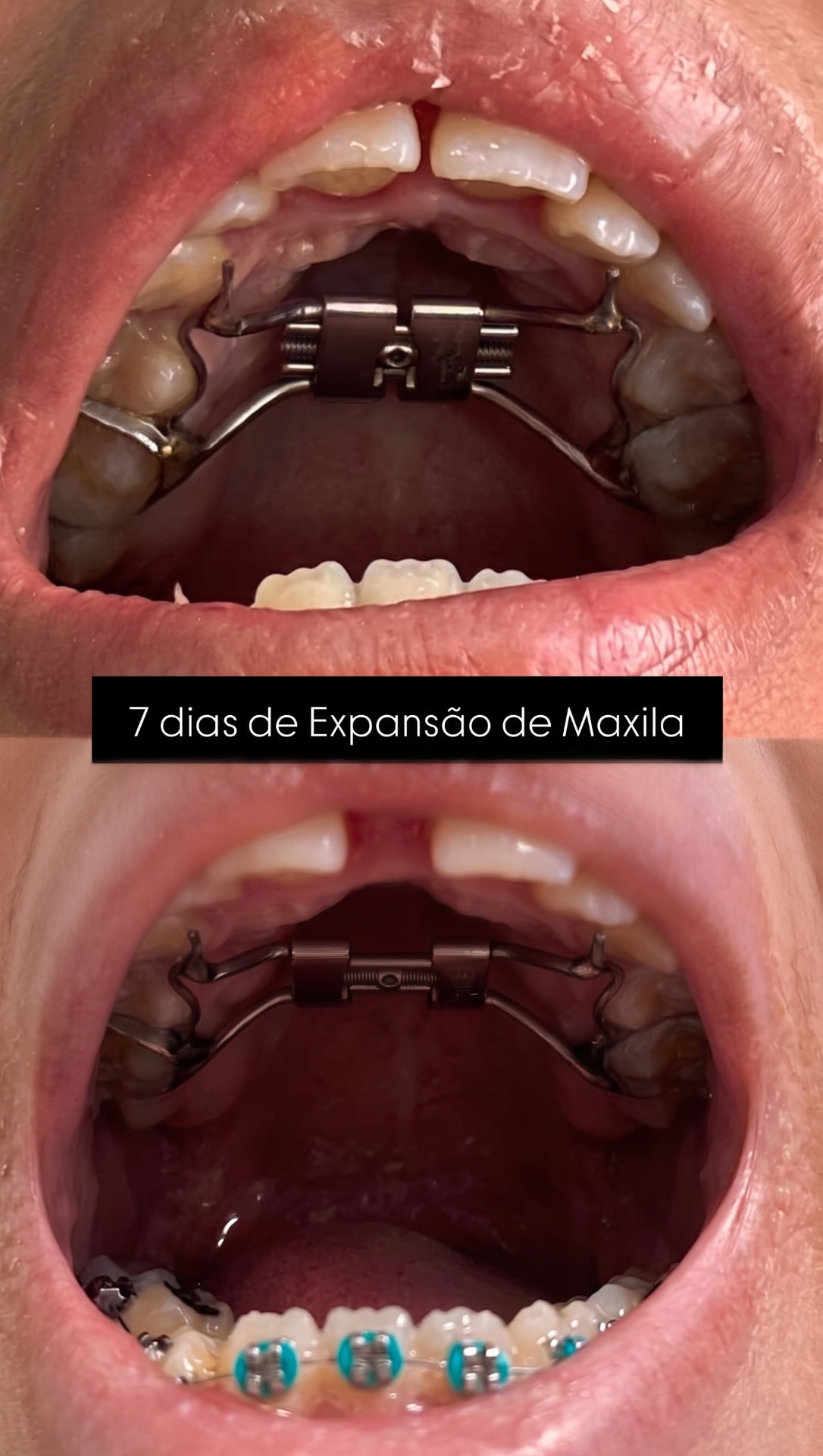 Vista intraoral do palato antes e depois de 7 dias de expansão de maxila, mostrando a abertura do diastema entre os incisivos centrais superiores