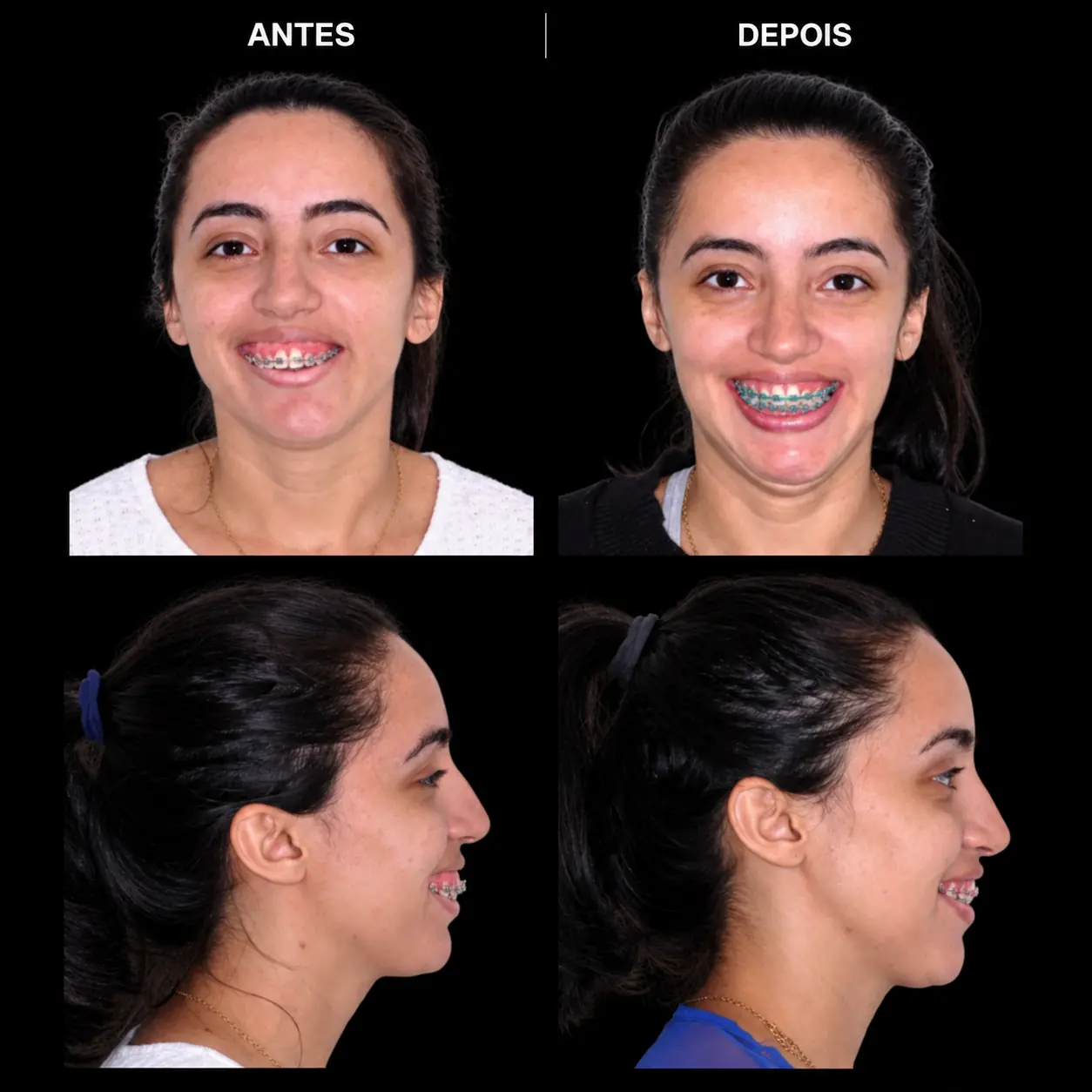 Antes e depois de cirurgia ortognática no Rio de Janeiro — Correção de Classe III com harmonização do terço inferior. Fotos pré e pós-operatórias de paciente do Dr. Guilherme Lima, cirurgião bucomaxilofacial.
