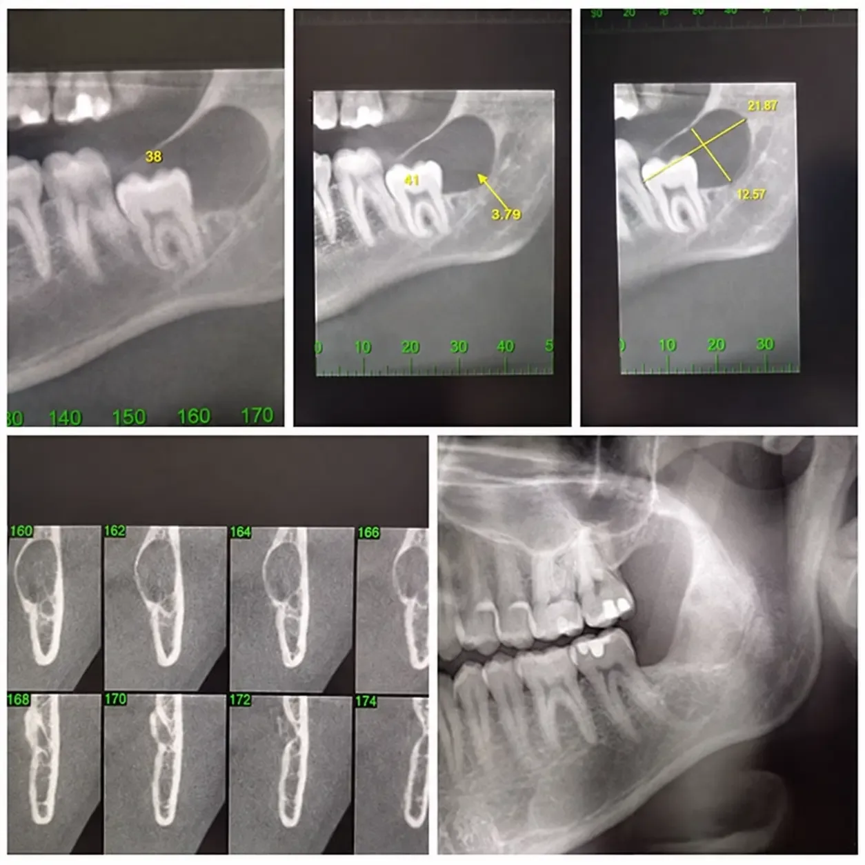 Radiografias e cortes de tomografia de lesão radiolúcida ao redor da coroa de um siso inferior incluso, compatível com cisto dentígero