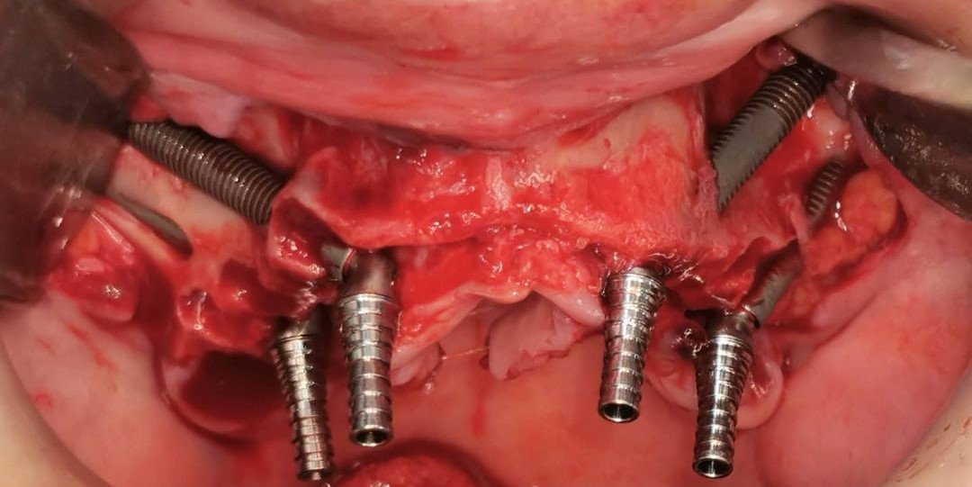 Implantes zigomáticos e convencionais instalados no maxilar durante a cirurgia