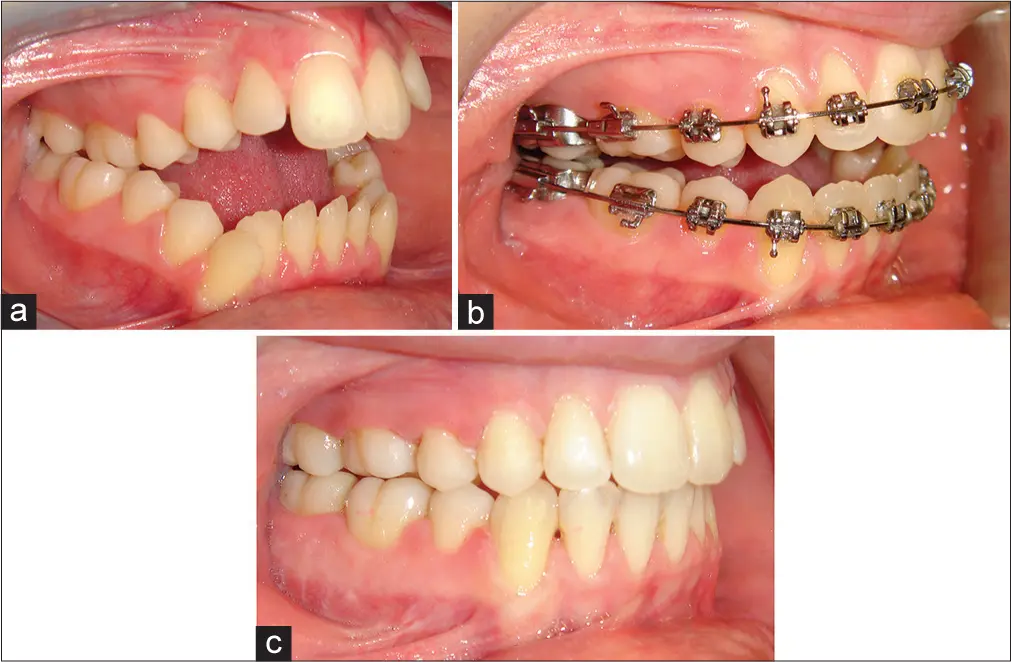 Sequência clínica intraoral em vista lateral: mordida aberta anterior inicial, fase de ortodontia com aparelho fixo e oclusão com contato dos dentes anteriores após o tratamento