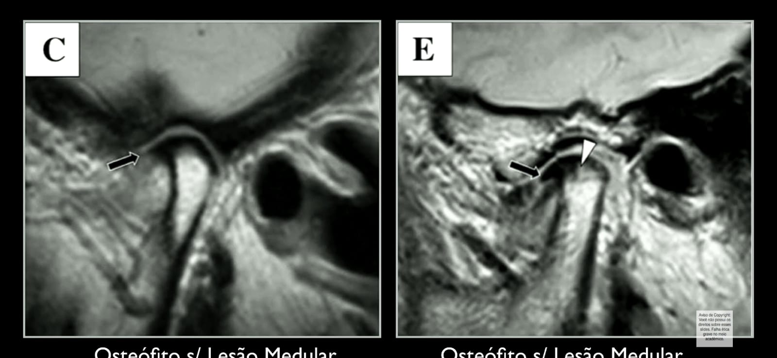 Ressonância magnética da ATM mostrando osteófito no côndilo mandibular