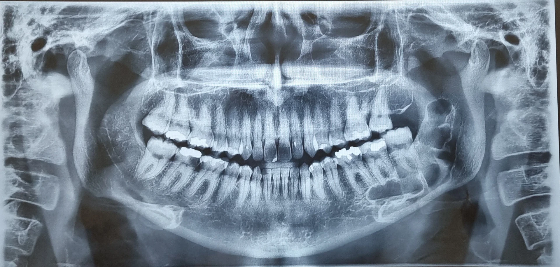 Radiografia panorâmica utilizada na avaliação inicial