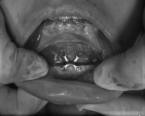 Detalhe intraoral da osteossíntese do mento com miniplaca e parafusos de titânio após reposicionamento ósseo