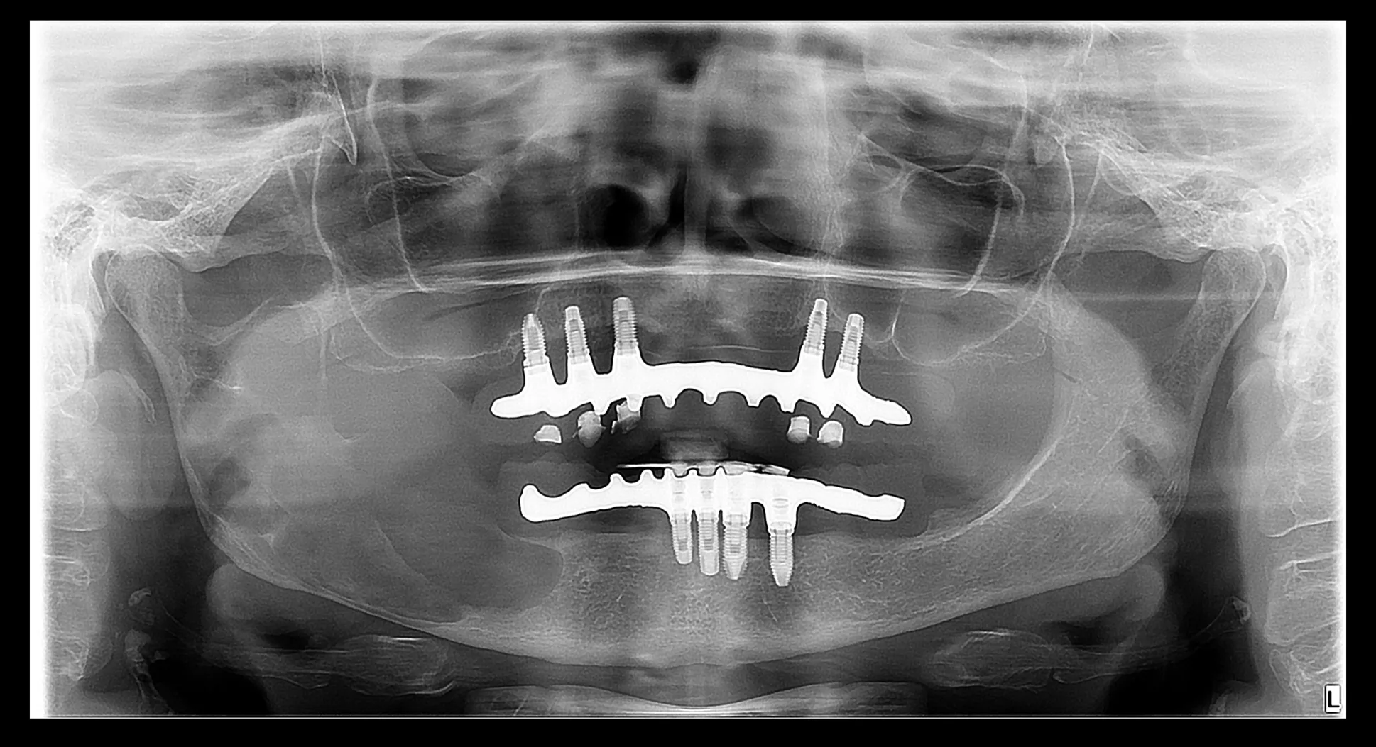 Antes do tratamento: tumor odontogênico queratocístico (ceratocisto) no corpo da mandíbula do lado direito, visto como uma área escura extensa na radiografia panorâmica, em paciente com próteses fixas sobre implantes.