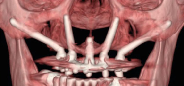 Reconstrução 3D da tomografia com implantes zigomáticos apoiados no osso da maçã do rosto