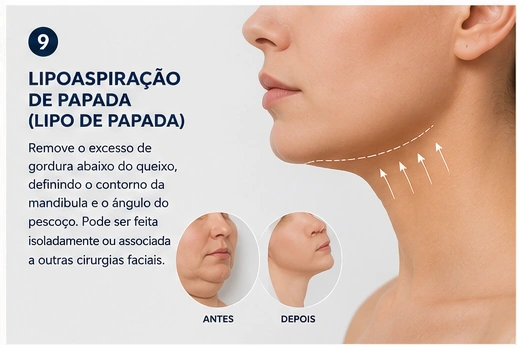 Lipo de papada — definição do contorno mandibular