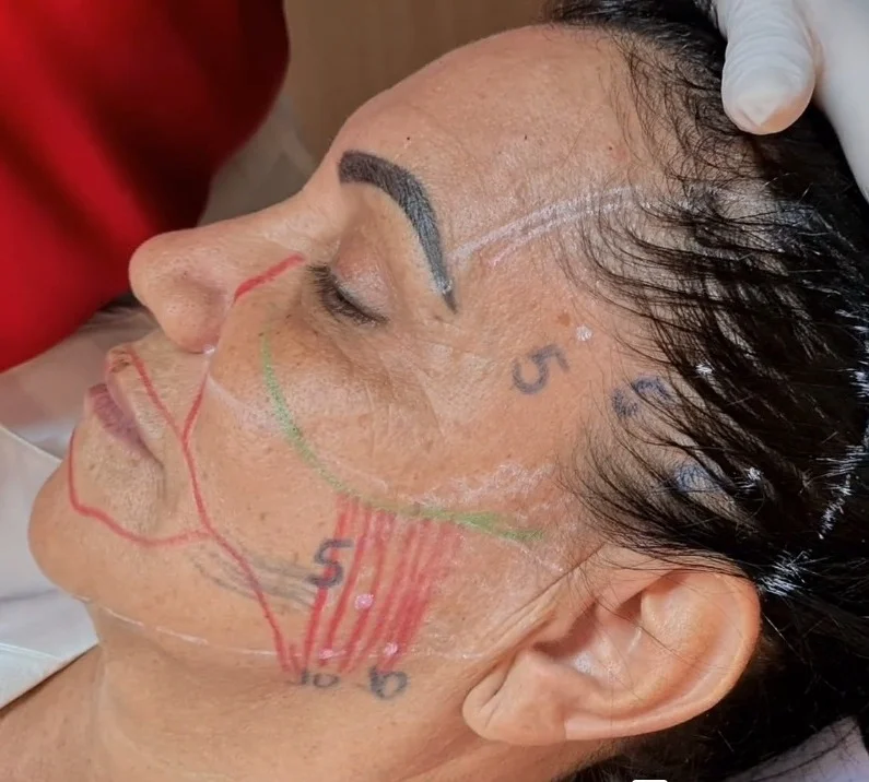 Marcação dos músculos masseter e temporal antes da aplicação de toxina botulínica para dor de ATM