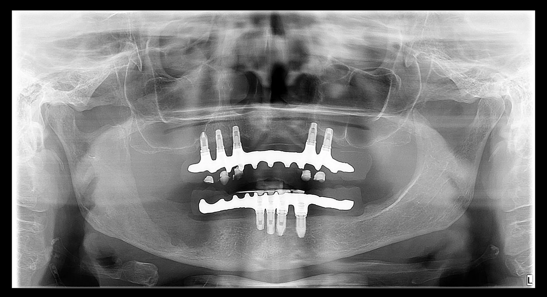 Depois do tratamento: o mesmo paciente, com sinais de regeneração óssea na área onde estava a lesão. O ceratocisto pode voltar, por isso o acompanhamento com radiografias continua por anos.