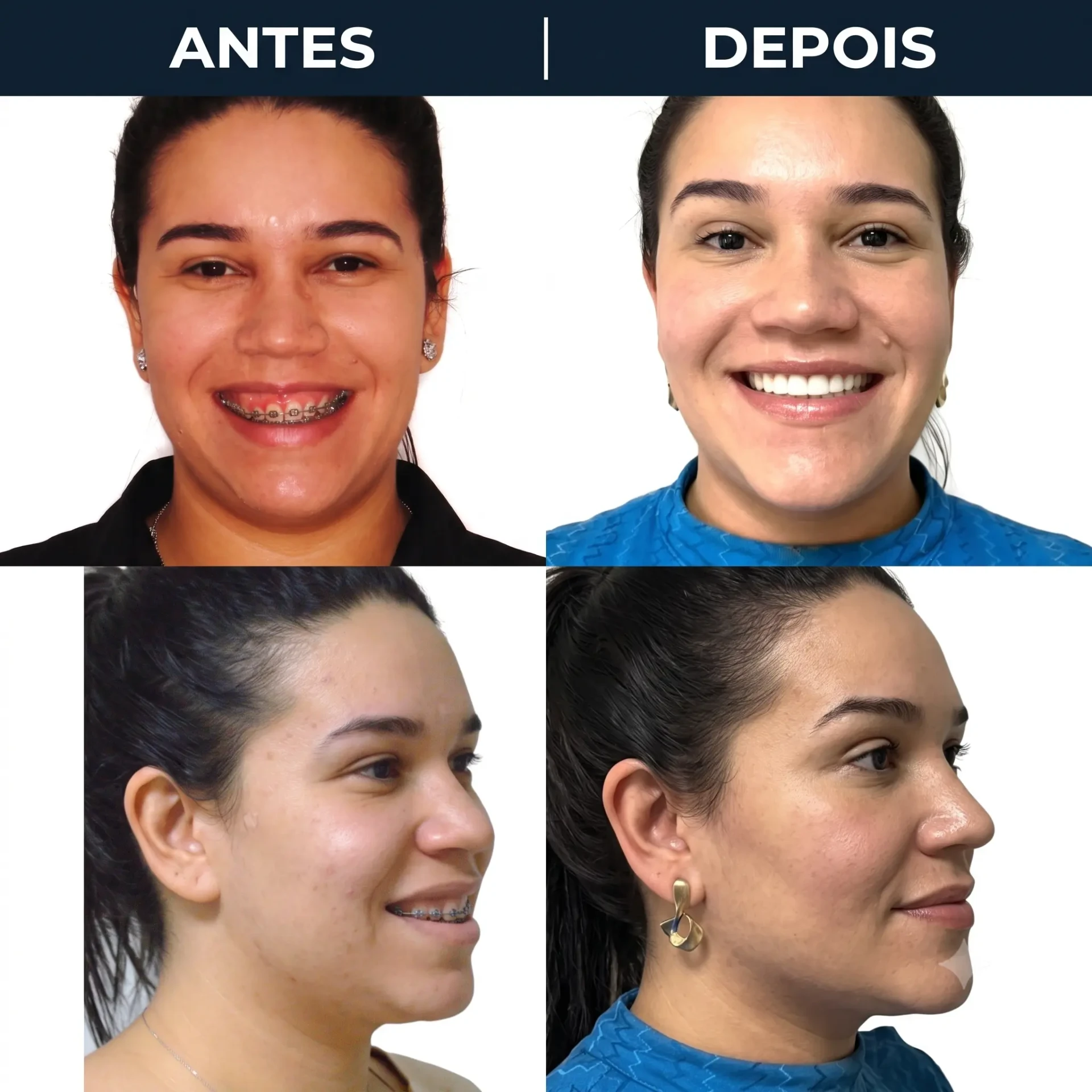 Antes e depois de cirurgia ortognática em Angra dos Reis — paciente feminina, vistas frontal e de perfil, tratada pelo Dr. Guilherme Lima