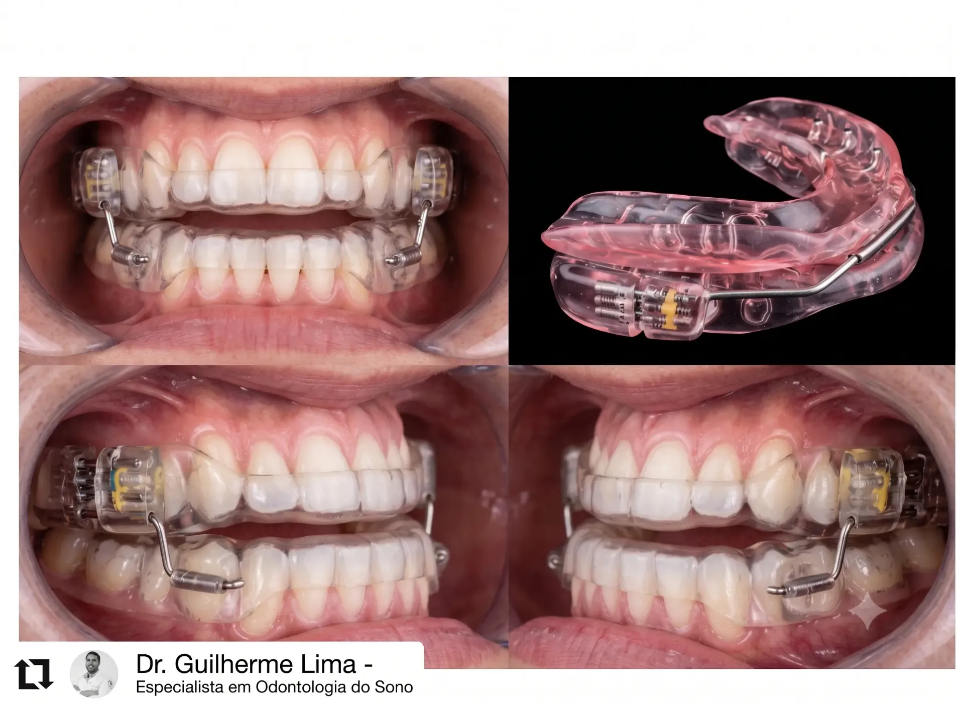 Aparelho intraoral tipo PM instalado — vistas frontal e laterais
