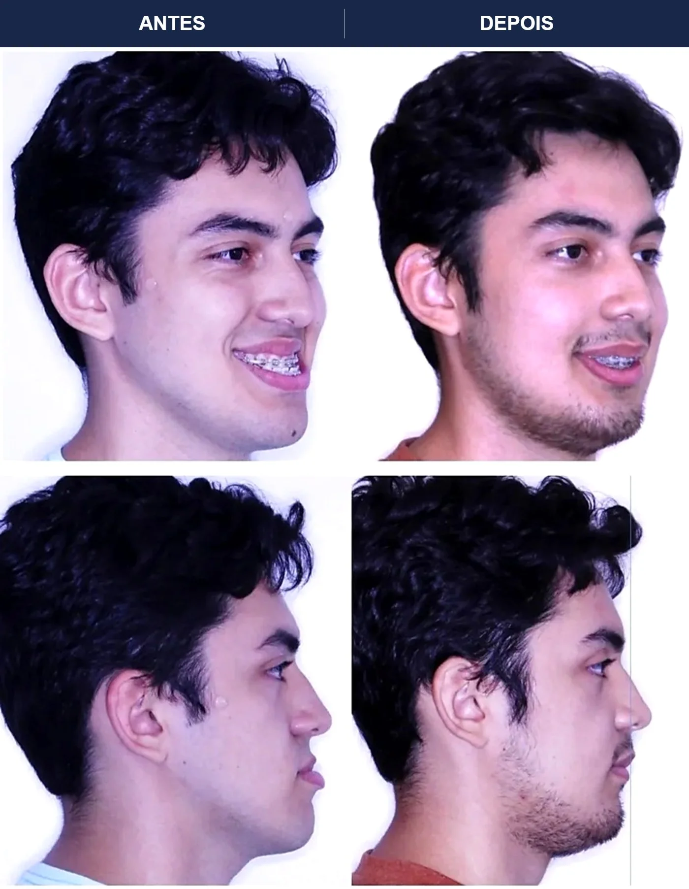 Caso clínico de cirurgia ortognática — Correção de Classe III — vistas em três quartos e perfil. Imagens pré e pós-operatórias.