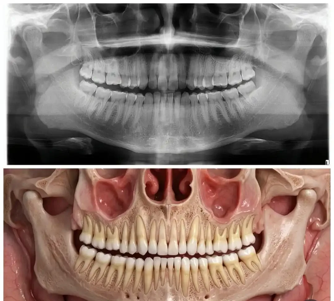 Radiografia panorâmica comparada a ilustração anatômica dos maxilares, dentes e seios maxilares