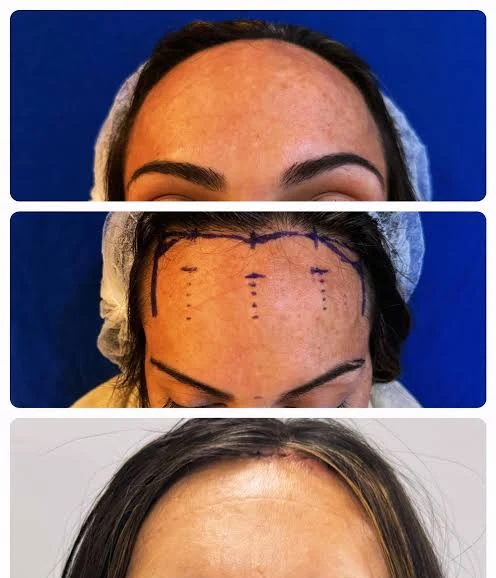 Frontoplastia: linha capilar original, marcação do planejamento cirúrgico e nova linha do cabelo
