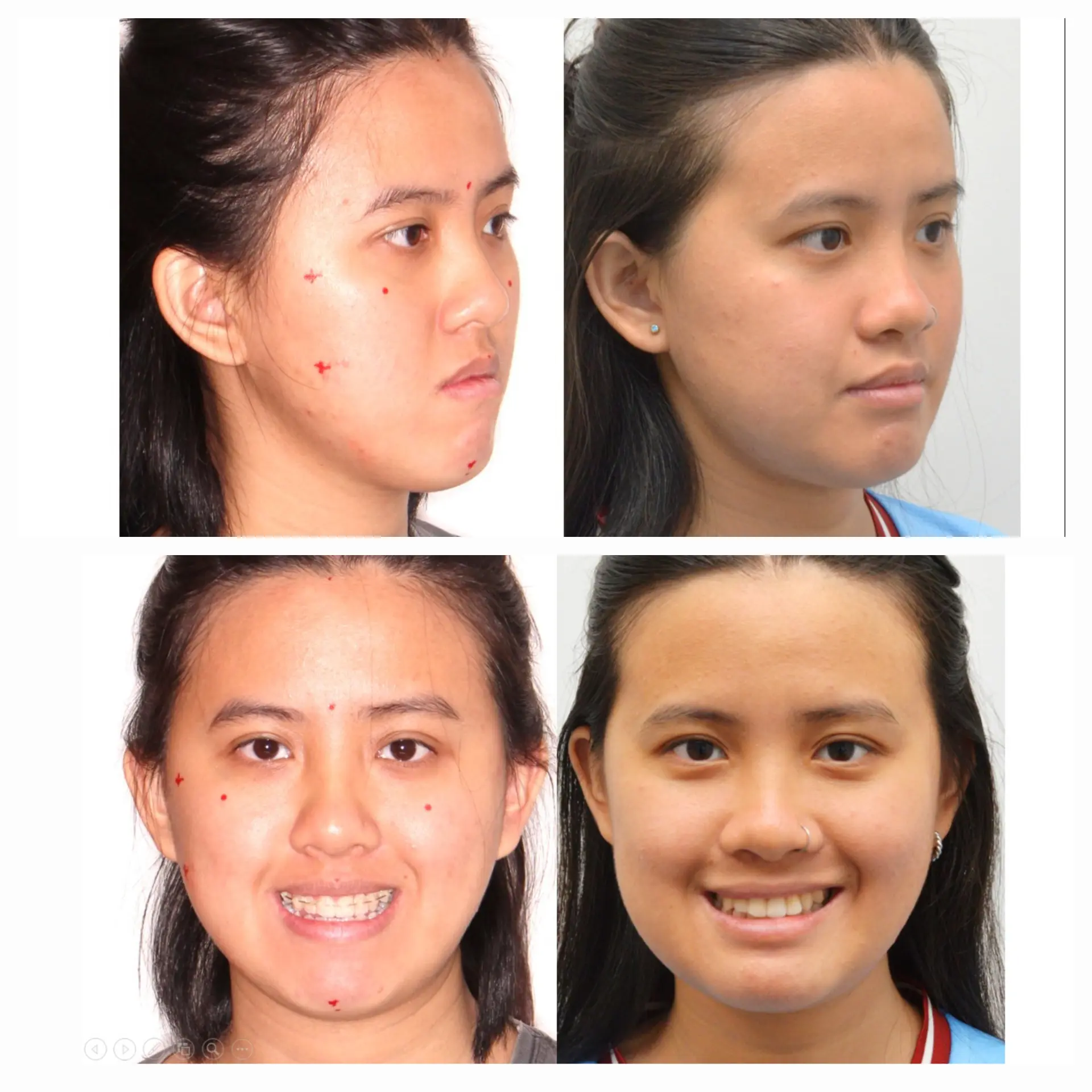 Antes e depois de cirurgia ortognática no Rio de Janeiro — Correção de assimetria facial e do contorno mandibular. Fotos pré e pós-operatórias de paciente do Dr. Guilherme Lima, cirurgião bucomaxilofacial.