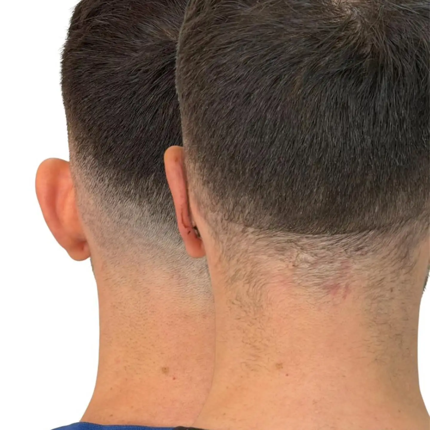 Vista posterior pré e pós-operatória de otoplastia