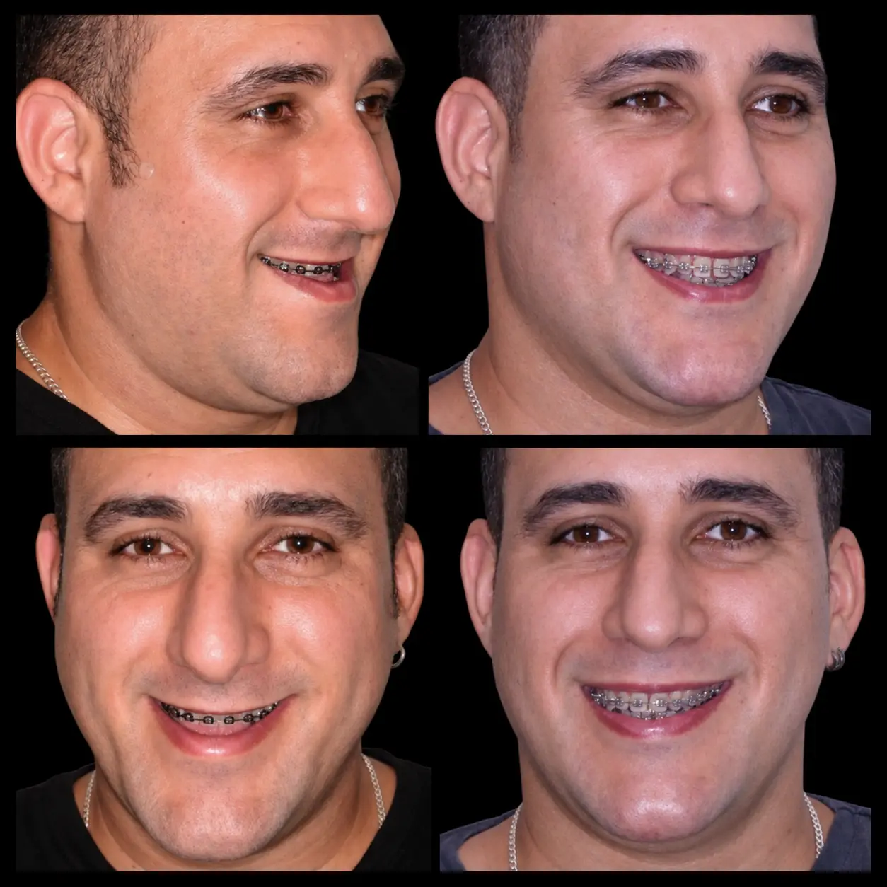 Registro fotográfico pré e pós-operatório de paciente com prognatismo mandibular associado a deficiência de maxila (Classe III esquelética)