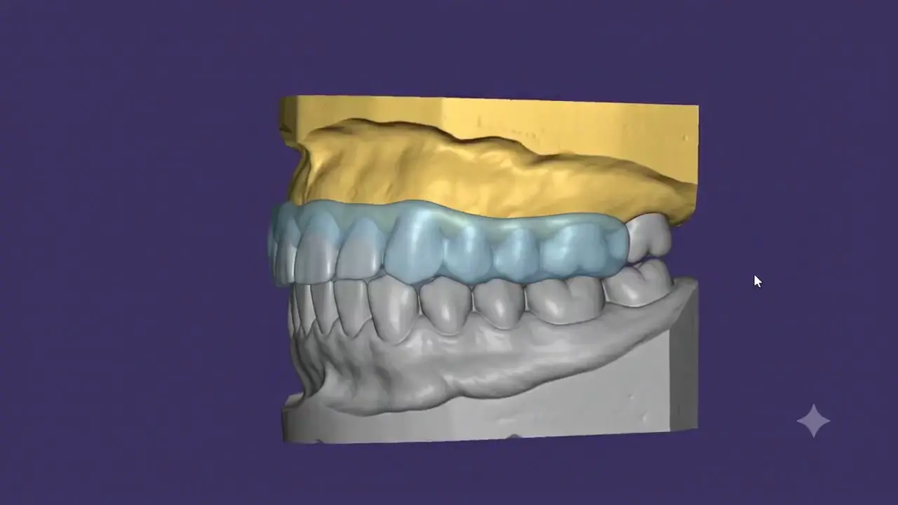 Vídeo demonstrando placa oclusal para bruxismo do sono