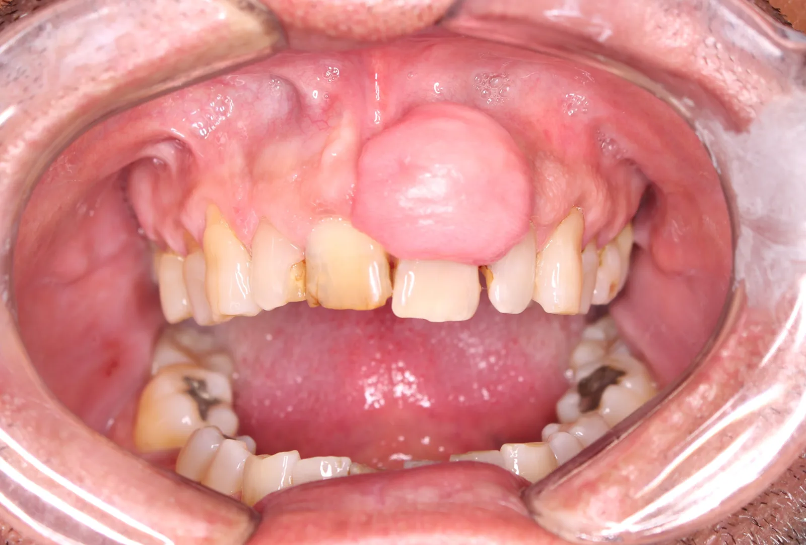 Nódulo firme e liso na gengiva acima dos dentes da frente superiores