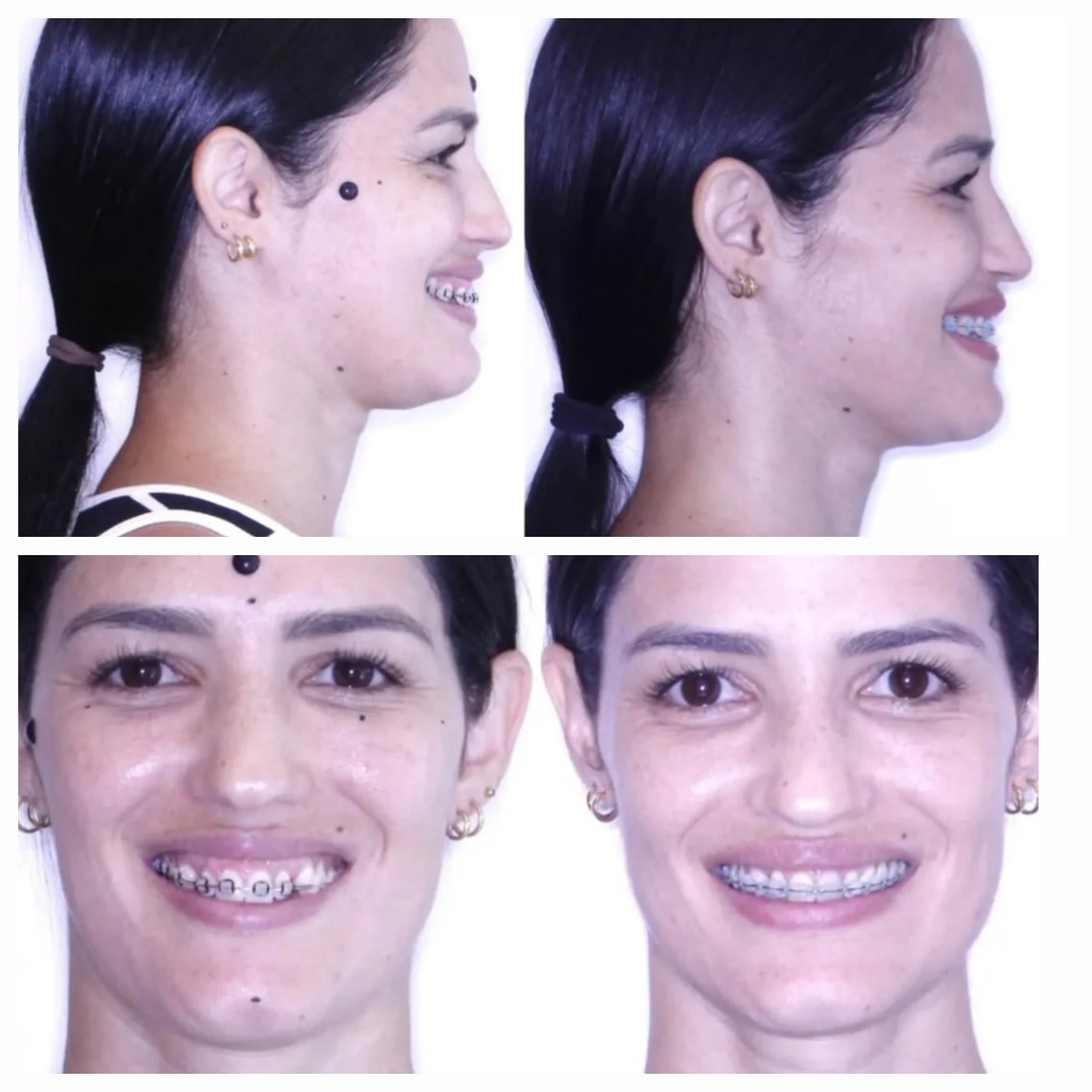 Antes e depois de cirurgia ortognática no Rio de Janeiro — Correção de Classe III com projeção do terço inferior. Fotos pré e pós-operatórias de paciente do Dr. Guilherme Lima, cirurgião bucomaxilofacial.