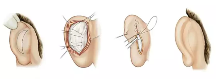 Ilustração das etapas da otoplastia: marcação retroauricular, exposição e remodelação da cartilagem, suturas de moldagem e contorno final da orelha
