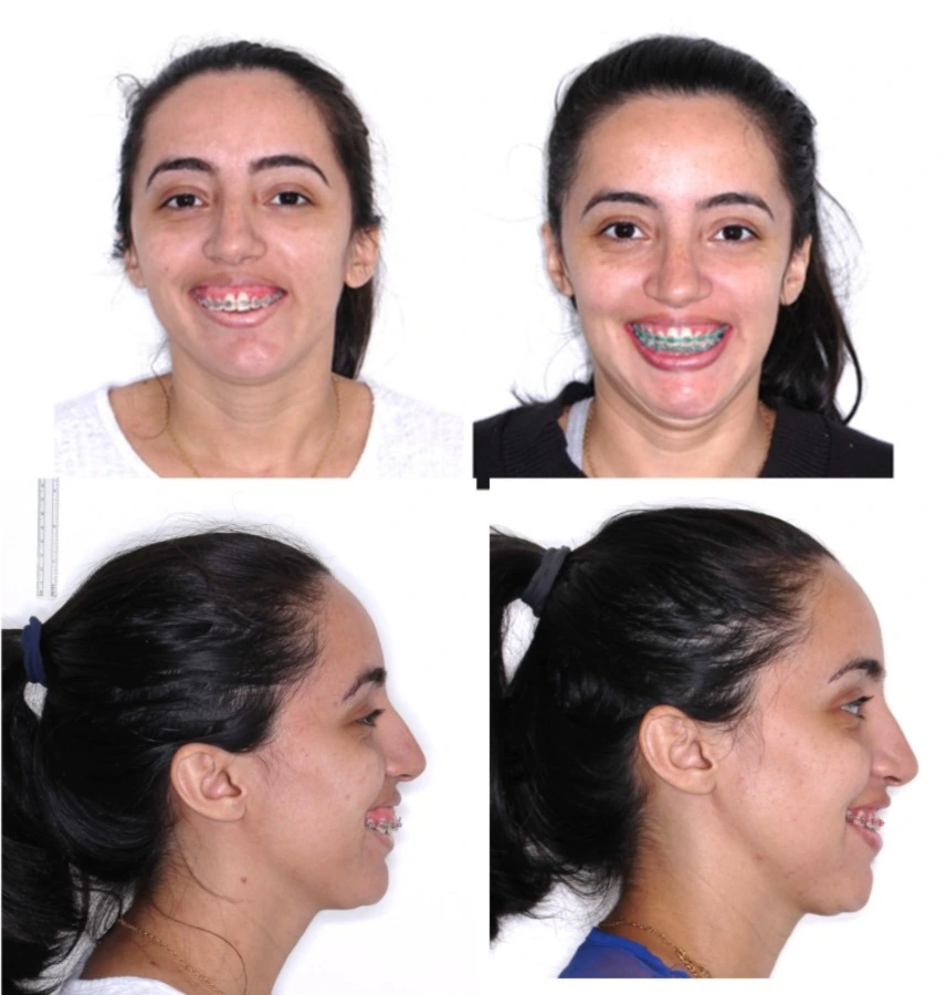 Registro fotográfico pré e pós-operatório de paciente tratada por cirurgia ortognática para correção de assimetria facial