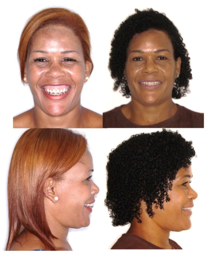 Caso clínico de sorriso gengival: comparação antes e após o tratamento, em vistas frontal e de perfil, com redução da exposição gengival ao sorrir