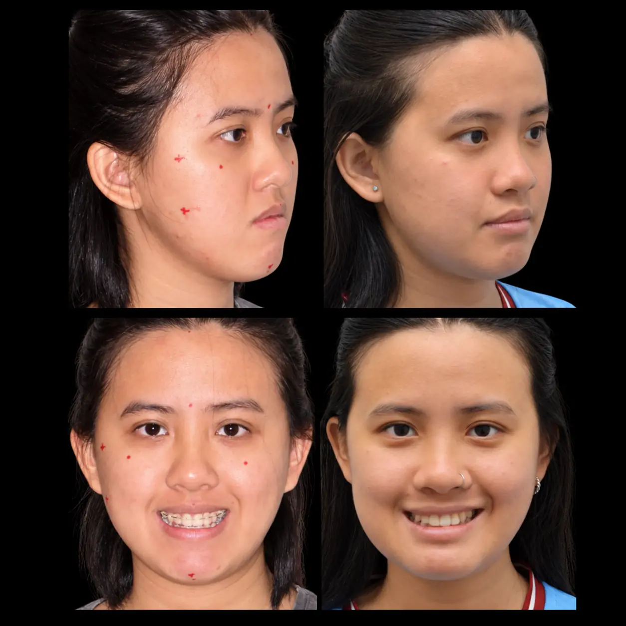 Antes e depois de cirurgia ortognática no Rio de Janeiro — Correção de assimetria facial e do contorno mandibular. Fotos pré e pós-operatórias de paciente do Dr. Guilherme Lima, cirurgião bucomaxilofacial.